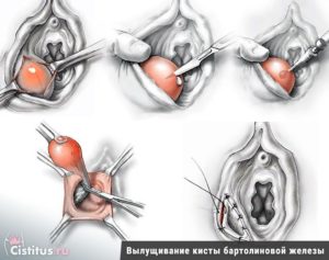 Воспаление бортовой железы у женщин. Воспаление бартолиновой железы — причины и лечение. Как лечить бартолинову железу? Анатомические изменения в бартолиновой железе при воспалении и кистозных опухолях