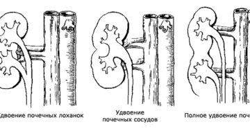 Удвоение почечного синуса левой почки. Причины удвоения почки