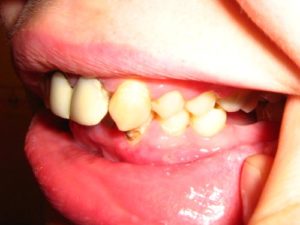 Как восстановить сломанный зуб. Сломал зуб что делать в первую очередь