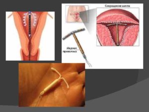 ВМС спираль: побочные действия, отзывы. Женское здоровье