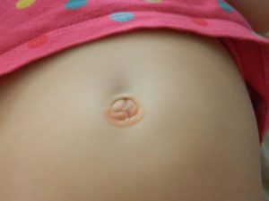 Пупочный свищ у ребенка симптомы и лечение. Пупочный свищ у грудничка: причины и стадии заболевания, а также методы лечения