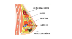 Может ли липома молочной железы быть раком? Липома молочной железы: причины, симптомы и методы лечения. Липома молочной железы: лечение народными средствами