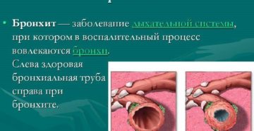 Обструктивный бронхит заразен. Бронхит – заразное заболевание или нет