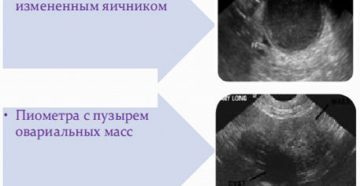 Всегда ли опасно кистозное изменение яичников? Что такое кистозное изменение яичника