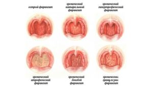 Не проходит фарингит 2 месяца. Долго не проходит фарингит, узнайте, как долго проходит фарингит