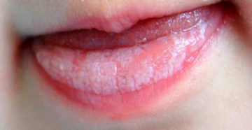Грибок в уголках губ под названием молочница или кандидоз: симптомы и лечение белого налета у взрослых. Почему развивается на губах грибковое поражение