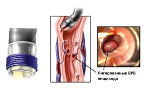 Эндоскопическое лигирование варикозно расширенных вен пищевода. Особенности легирования вен пищевода Лигирование поверхностных сосудов в ране