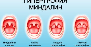 Рыхлые гланды как лечить. Причины и лечение рыхлых миндалин у ребенка и взрослого