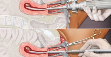 Если не делать чистку матки что будет. Повторная чистка матки: когда она нужна. С какой целью проводят выскабливание