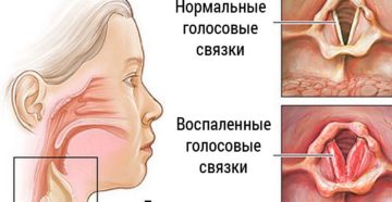 Лечение голосовых связок народными средствами. Воспаление голосовых связок: симптомы и лечение. Охрипший голос - что делать