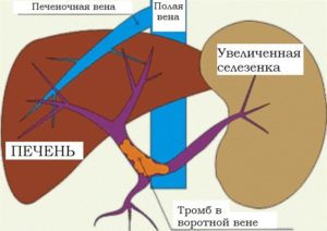 Селезеночная вена норма. Что такое тромбоз селезеночной вены