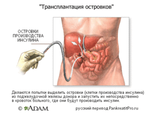 Сколько живут без поджелудочной железы. Удаление поджелудочной железы: показания к проведению, виды операции, последствия