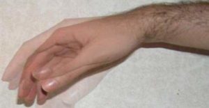 Трясется рука после физической нагрузки. Причины симптомы и лечение тремора рук
