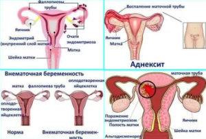 После незащищенного акта тянет низ живота. Что делать, если после секса болит низ живота