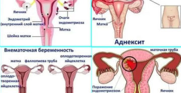 После незащищенного акта тянет низ живота. Что делать, если после секса болит низ живота