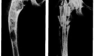 Фиброзно кистозная дисплазия плечевой кости. Фиброзная дисплазия. Фиброзная дисплазия черепа: лечение