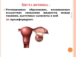 Ретенционное образование яичника. Ретенционное образование правого яичника