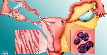 Основные противопоказания при эндометриозе матки. Эндометриоз. Причины, симптомы, современная диагностика, эффективное лечение болезни
