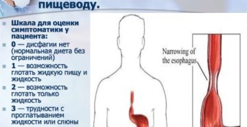 Пища не проходит в пищевод. Нарушения прохождения пищи по пищеводу