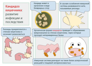 О чем говорят дрожжи в кале. Методы лечения молочницы у ребенка. Каким образом дрожжи попадают в кал