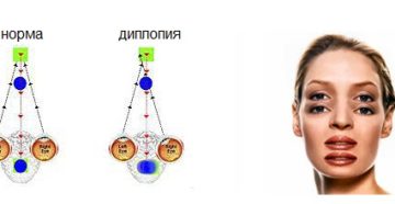 Как лечить диплопию народными средствами? Диплопия