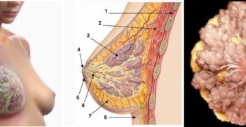 Фам правой молочной железы лечение. Лок фам молочной железы что это такое. Симптомы и формы фиброаденоматоза