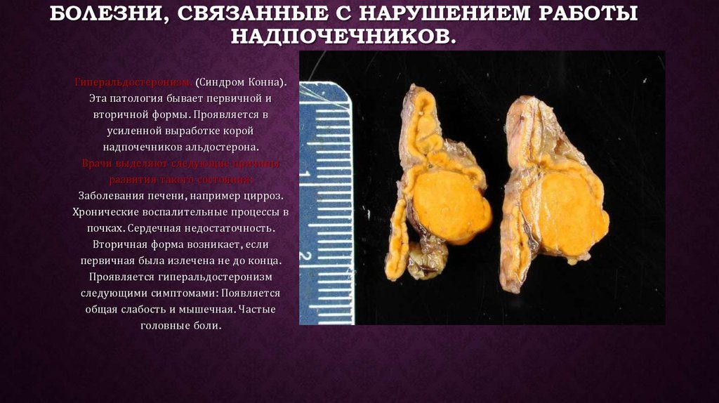 В мозговом слое надпочечников синтезируются. Причины нарушения работы. Симптомы надпочечниковой гиперандрогении