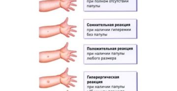 Можно ли делать манту после болезни ребенку: чего ожидать? Манту: когда делают, и через сколько времени после болезни допускается проводить пробу